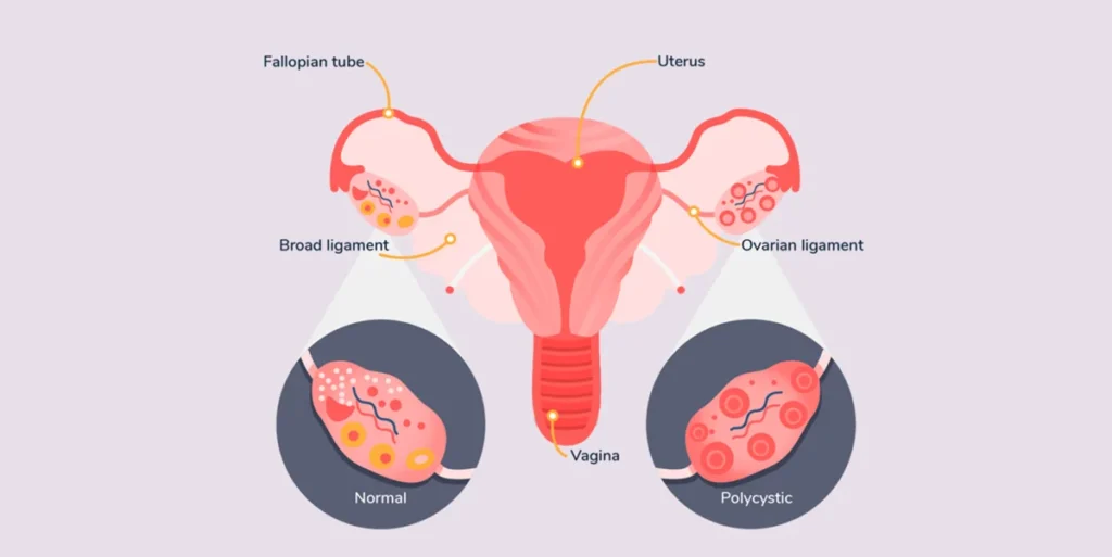 علاج تكيس المبايض للمتزوجة بالأدوية