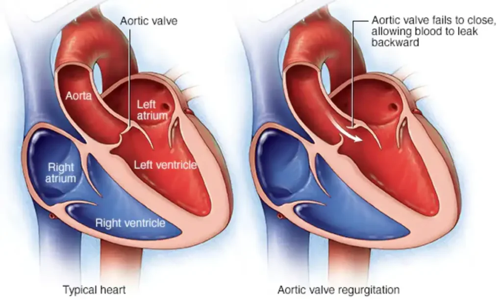 علاج ارتجاع الصمام الأورطي بالادوية